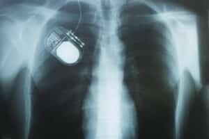 X-ray of a nerve stimulation device in a patient's chest to stimulate the vagus nerve and minimize pain