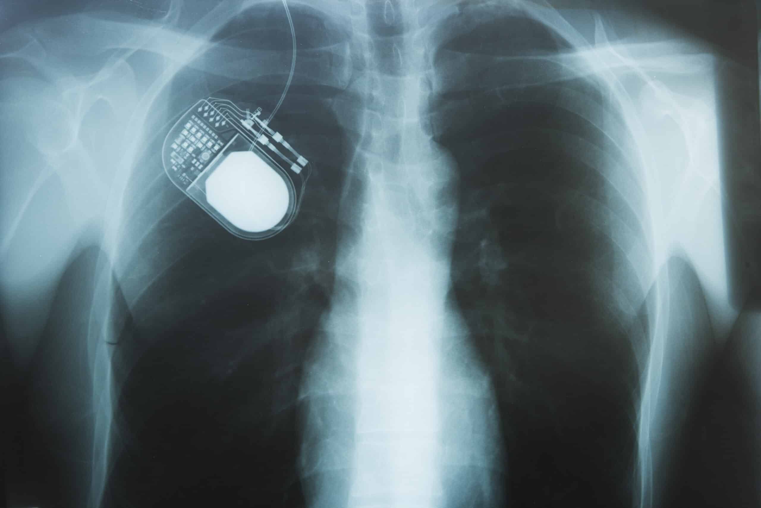 X-ray of a nerve stimulation device in a patient's chest to stimulate the vagus nerve and minimize pain