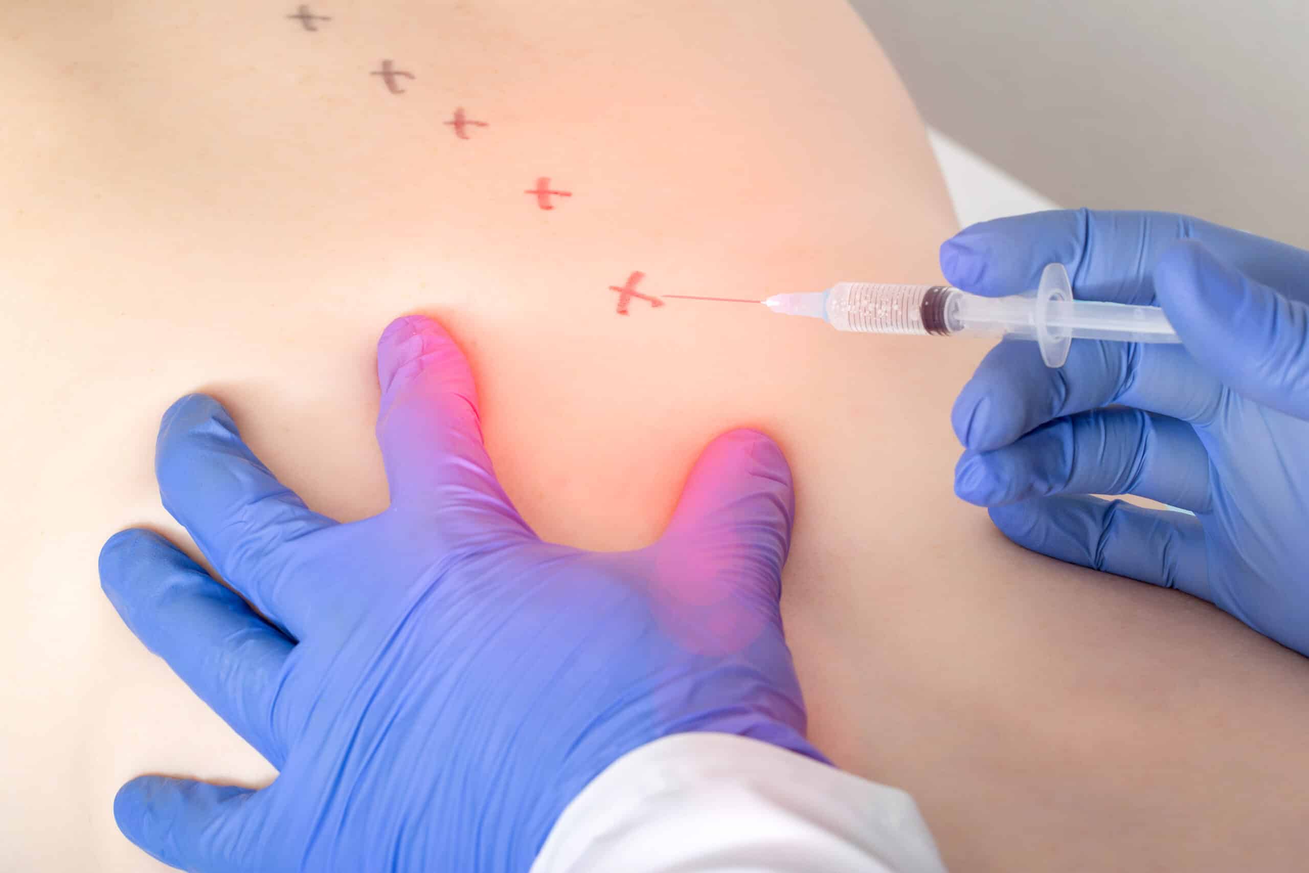 Close up of a doctor administering a trigger point injection into a patient's spine for pain relief