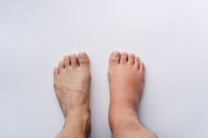Close-up of a patient's feet, one swollen and warm as a symptom of Compartmental Regional Pain Syndrome.