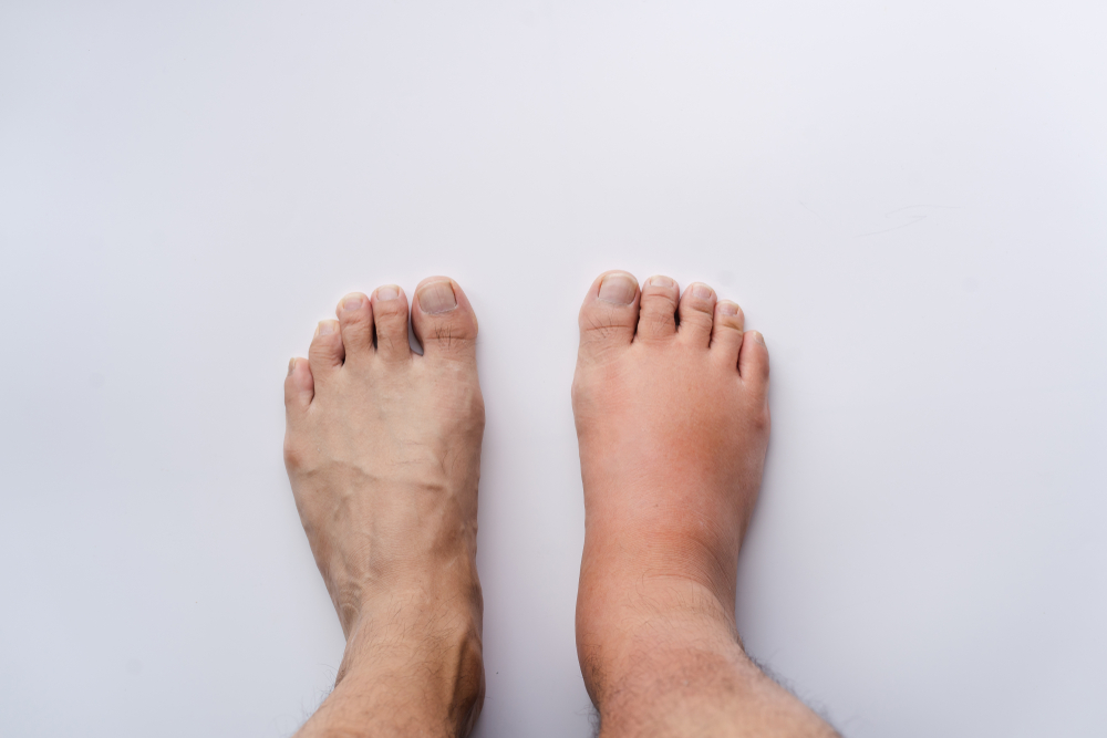 Close-up of a patient's feet, one swollen and warm as a symptom of Compartmental Regional Pain Syndrome.